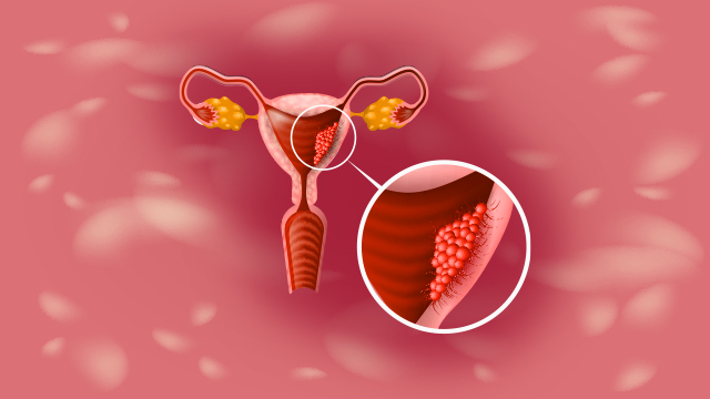 Endometrial Cancer Symptoms and Causes