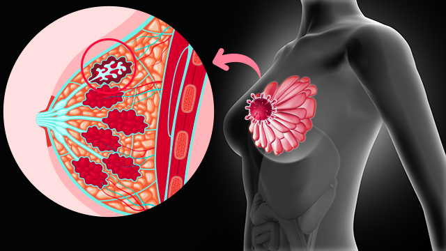 Symptoms and Causes of Breast Cancer