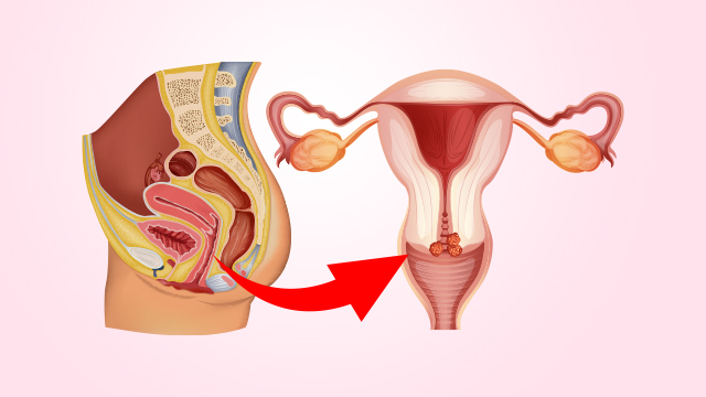 Symptoms and Causes of Cervical Cancer