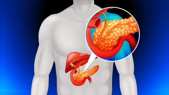 Symptoms and Causes of Pancreatic Cancer