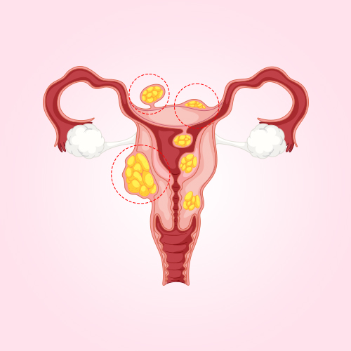 Type 1 Endometriosis