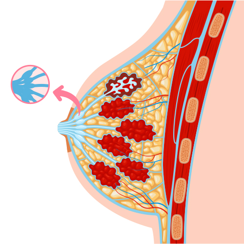 Ductal Carcinoma In Situ (DCIS)