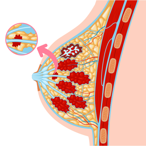 Invasive Lobular Carcinoma (ILC)