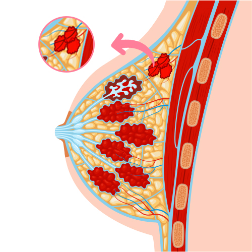 Triple-Negative Breast Cancer