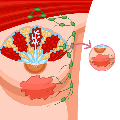 Inflammatory Breast Cancer (IBC)