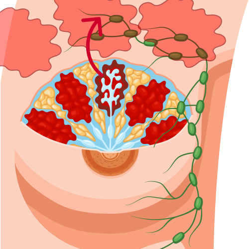 Metastatic Breast Cancer