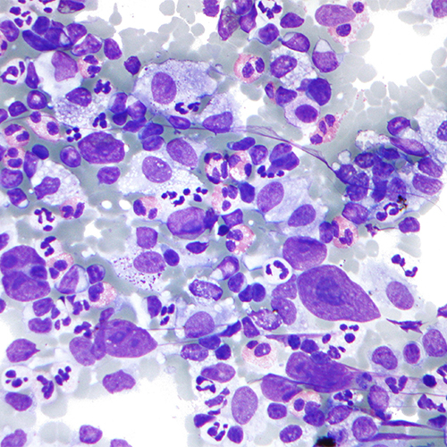 Hodgkin lymphoma (HL) 