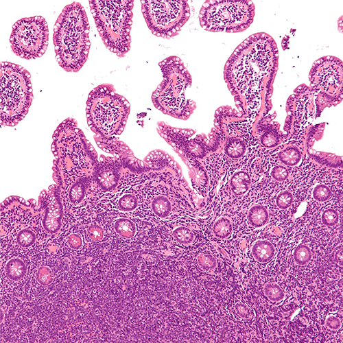 Non-Hodgkin lymphoma (NHL) 