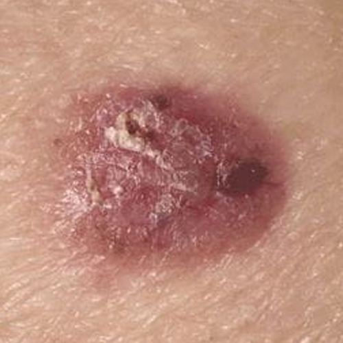 Basal cell carcinoma