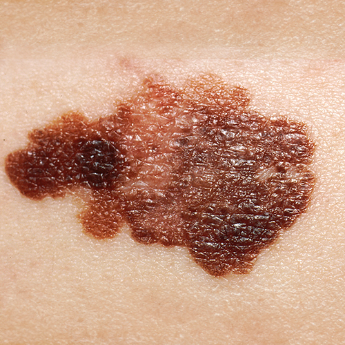 Melanoma