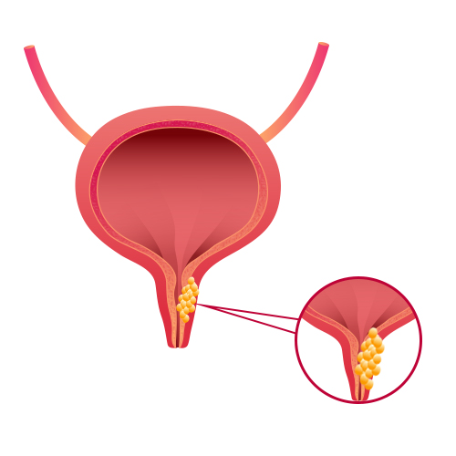 Adenocarcinoma