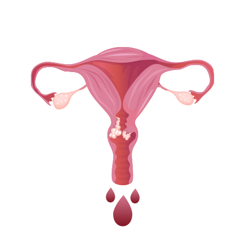 Abnormal vaginal bleeding or discharge, particularly postmenopausal