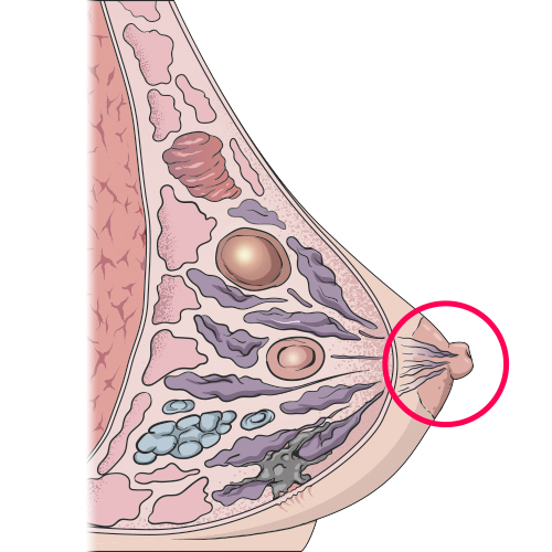 Nipple Abnormalities