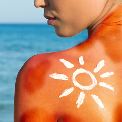 Risk Factors of Melanoma/Skin Cancer 