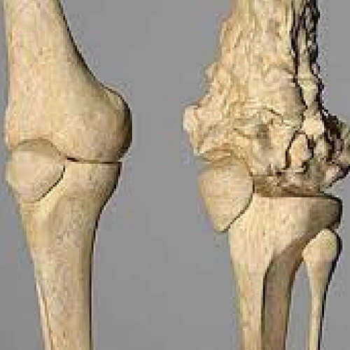 Osteosarcoma