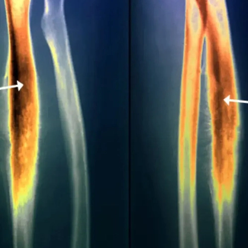 Ewing Sarcoma