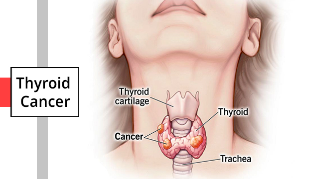 The Symptoms of Thyroid Cancer