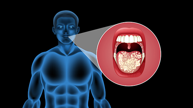 Oral Cancer Treatment