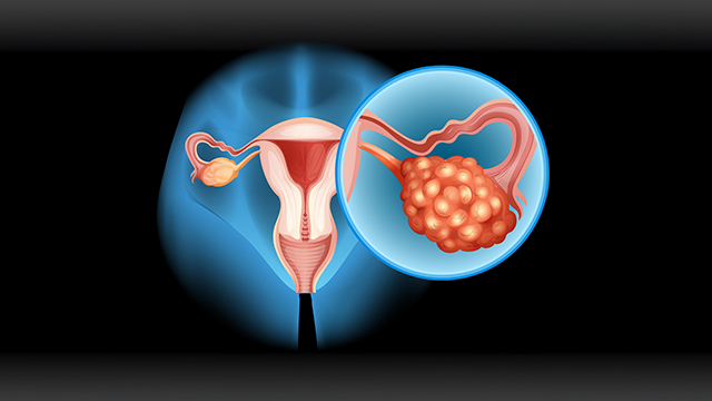 Signs and Symptoms Of Ovarian Cancer