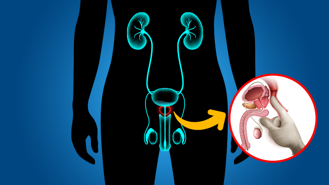 Prostate Cancer Treatment