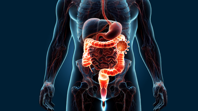 Understanding Colon Cancer 