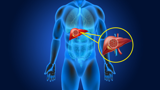 Signs and  Symptoms of Liver Cancer