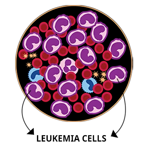 Leukemia