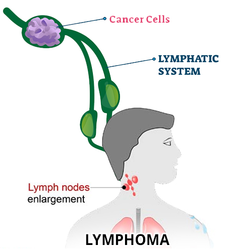 Lymphoma