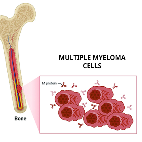 Multiple Myeloma