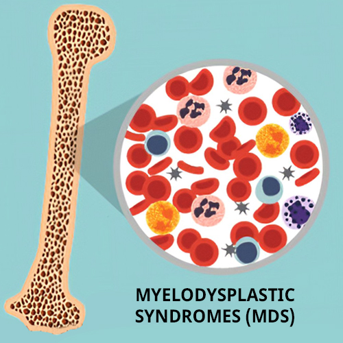 Myelodysplastic Syndromes (MDS)