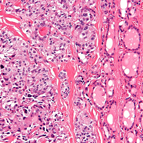 Medullary Thyroid Cancer (MTC)