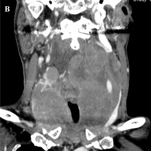 Thyroid Lymphoma 