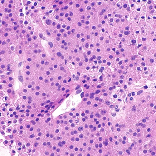 Thyroid Hurthle Cell Carcinoma