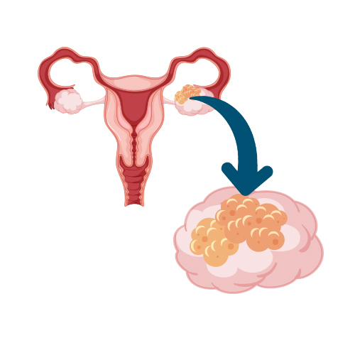 Epithelial Tumors