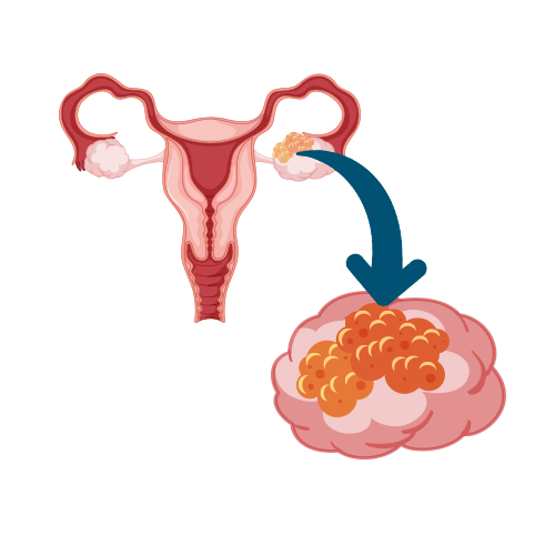 Germ Cells Tumors