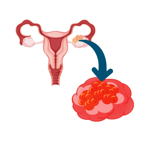 Stromal Cell Tumors 