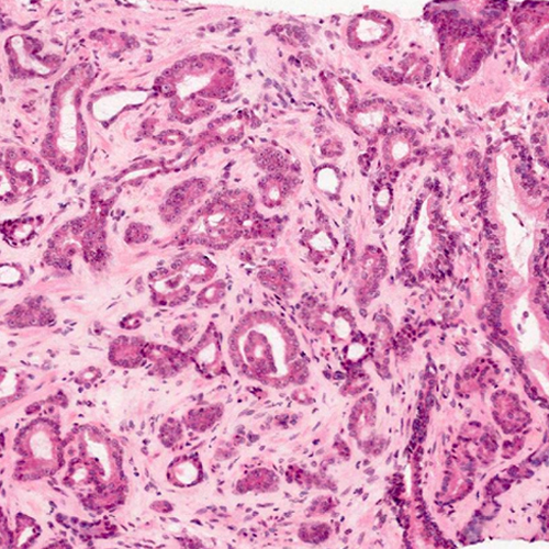 Adenocarcinoma