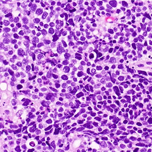 Small cell carcinoma