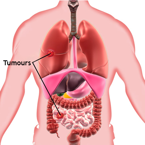 Neuroendocrine tumors