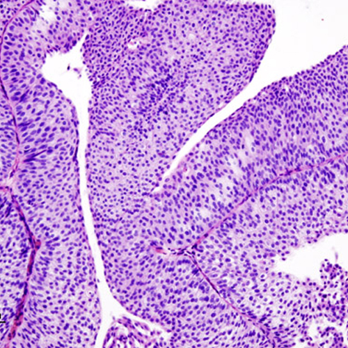 Transitional cell carcinoma