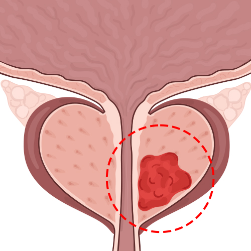 Sarcoma