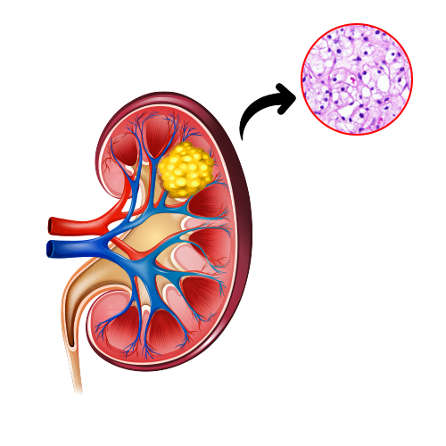 Clear Cell Carcinoma