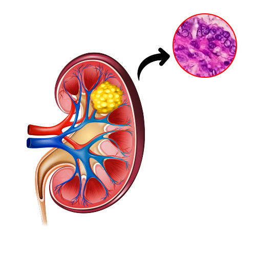 Papillary Carcinoma