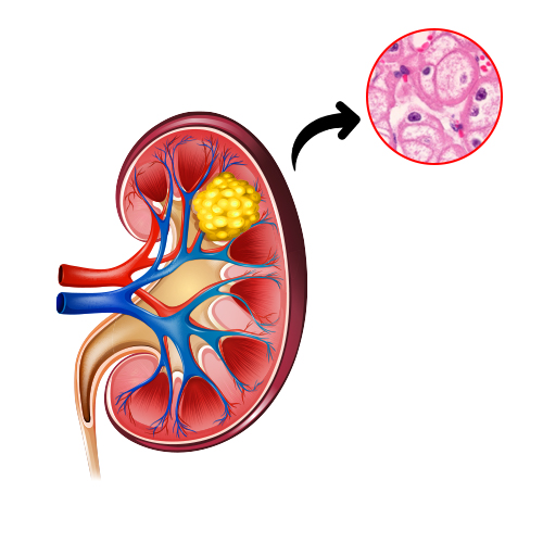 Chromophobe Carcinoma