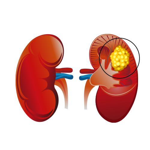 Renal Cell Carcinoma (RCC)