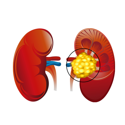 Wilms Tumor (Nephroblastoma)