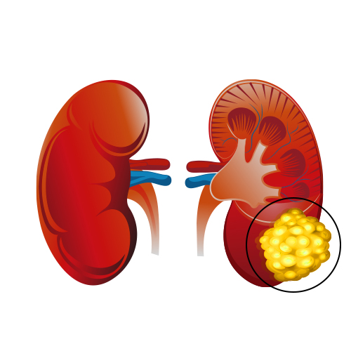 Renal Sarcoma