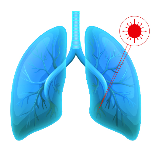 Combined small cell carcinomas 