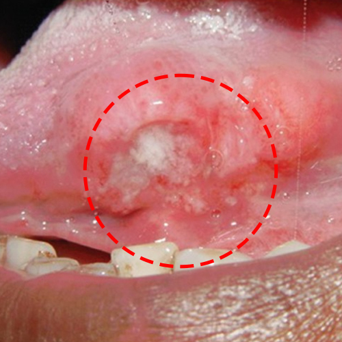 Squamous cell carcinoma 