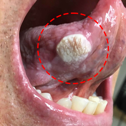 Verrucous carcinoma  